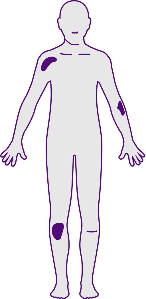 Infographic 1.2.4 A Plaque psoriasis severity - mild, moderate or severe