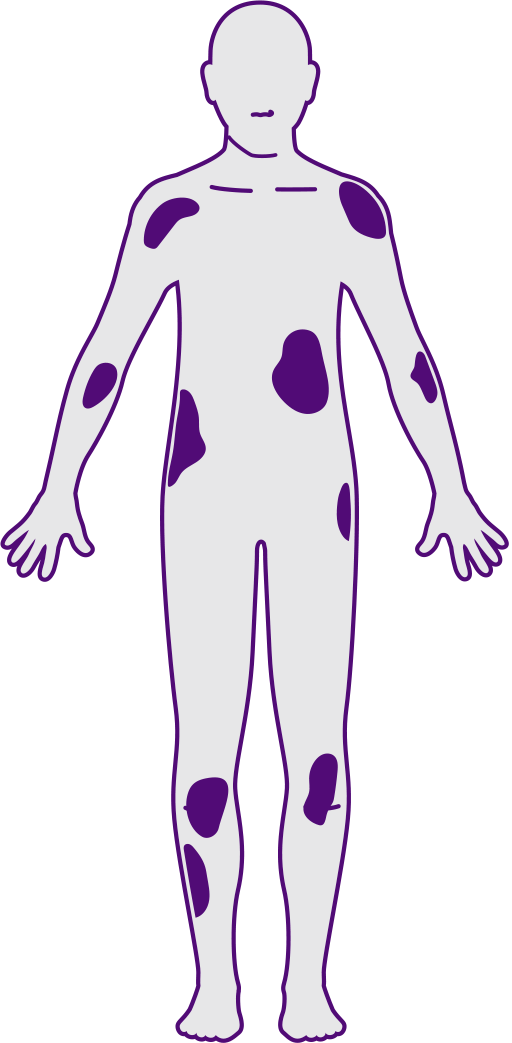 Infographic 1.2.4 A Plaque psoriasis severity - mild, moderate or severe