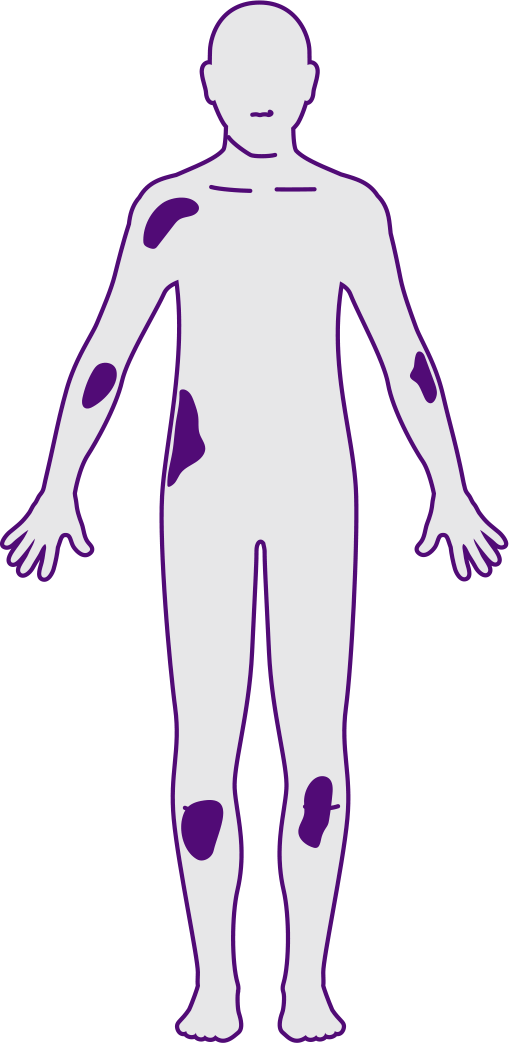 Plaque psoriasis severity - mild, moderate or severe